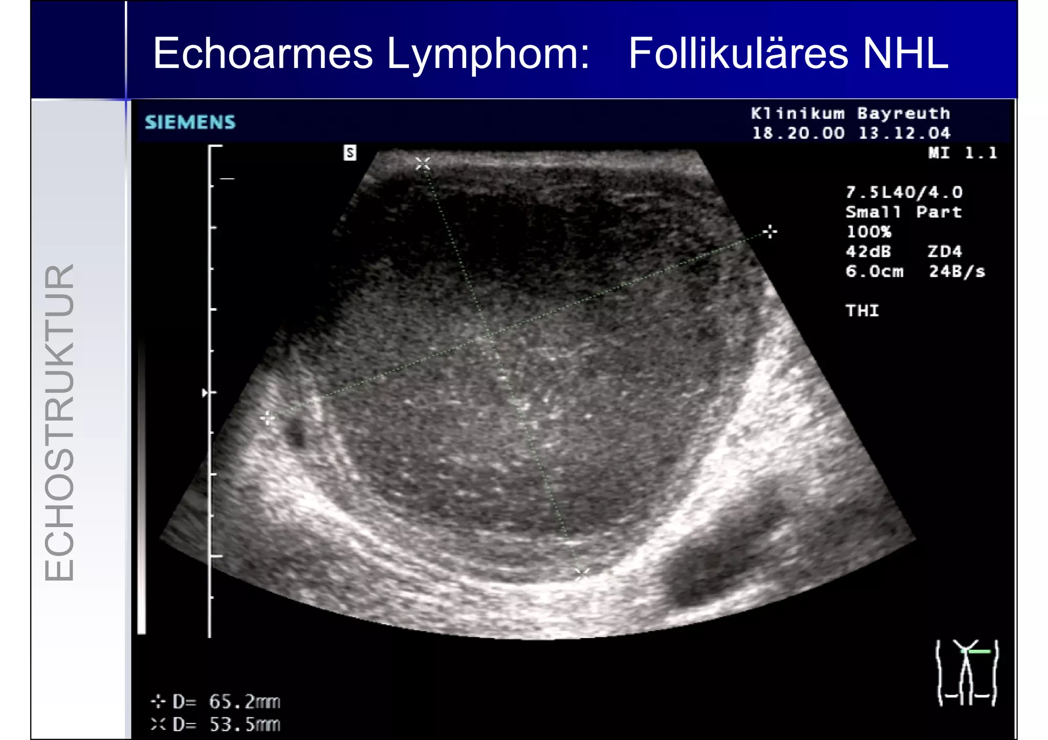 09 Lymphknotensonographie 2. Sonographietechnik der akuten Lymphknote…