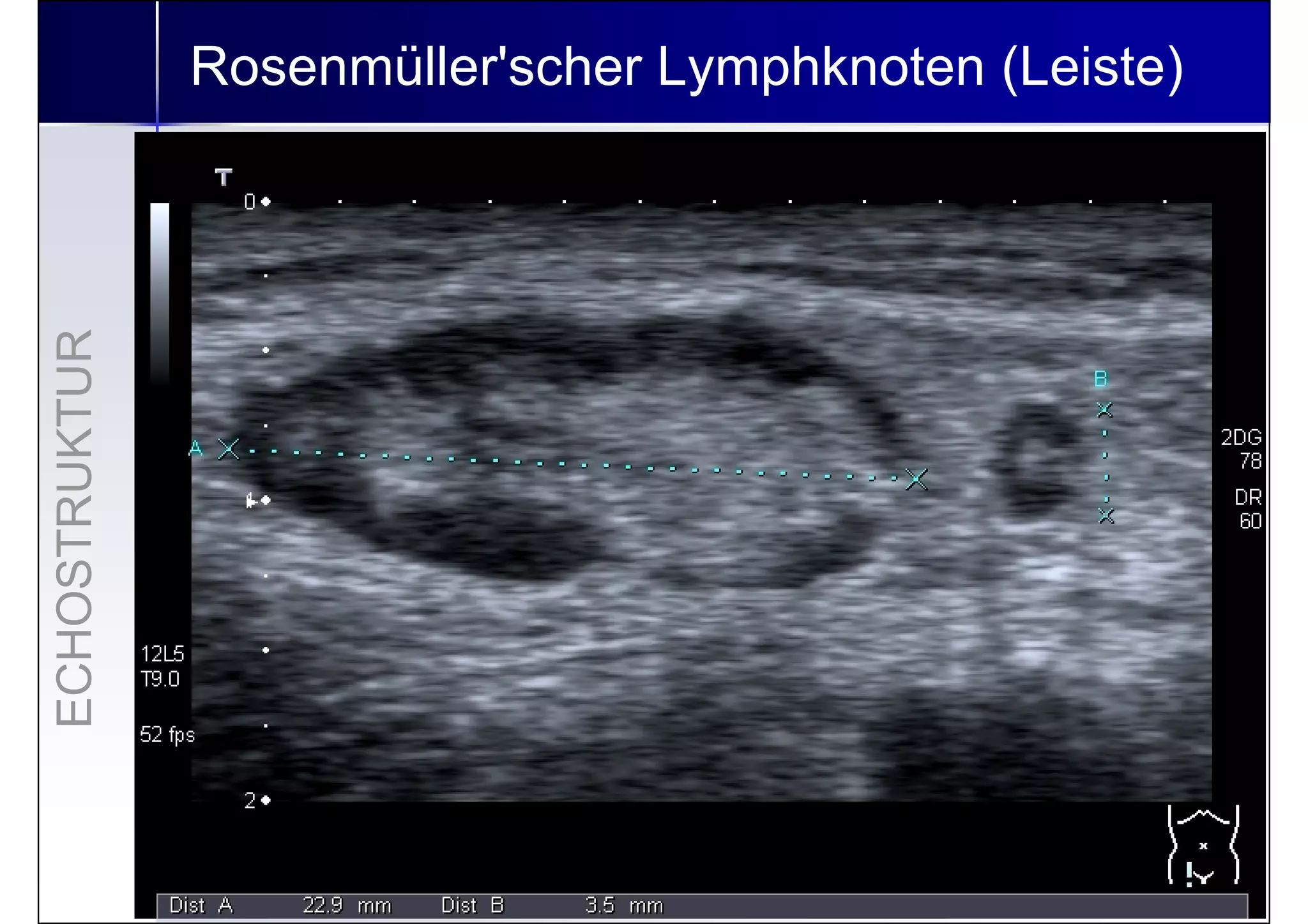 Lymphknoten Sonographie In Der Nähe www.slideshare.net