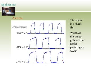 Asthma Applications The shape is a shark fin Width of the shape gets smaller as the patient gets worse 