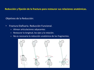 Reducción y fijación de la fractura para restaurar sus relaciones anatómicas.
Objetivos de la Reducción:
• Fractura Diafis...