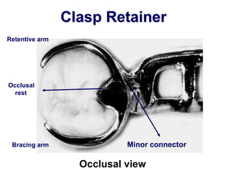 A- Retention of Removable Partial Dentures | PPT