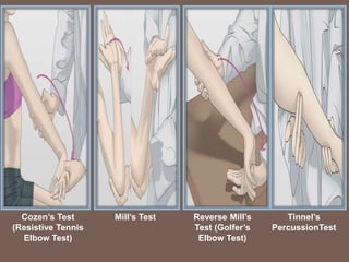 Cozen’s Test
(Resistive Tennis
Elbow Test)
Mill’s Test Reverse Mill’s
Test (Golfer’s
Elbow Test)
Tinnel’s
PercussionTest
 