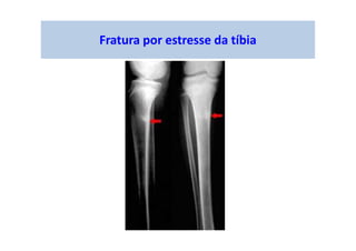 Fratura por estresse da tíbia
 