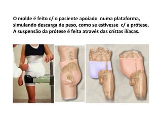O molde é feito c/ o paciente apoiado numa plataforma,
simulando descarga de peso, como se estivesse c/ a prótese.
A suspensão da prótese é feita através das crístas ilíacas.
 