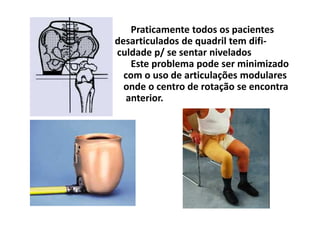 Praticamente todos os pacientes
desarticulados de quadril tem difi-
culdade p/ se sentar nivelados
Este problema pode ser minimizado
com o uso de articulações modulares
onde o centro de rotação se encontra
anterior.
 