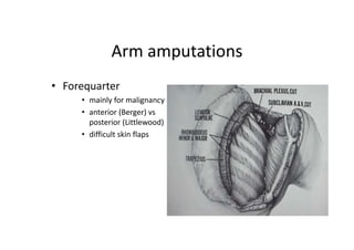 Arm amputations
• Forequarter
• mainly for malignancy
• anterior (Berger) vs
posterior (Littlewood)
• difficult skin flaps
 