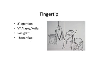Fingertip
• 2’ intention
• VY Atasoy/Kutler
• skin graft
• Thenar flap
 