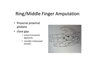 Ring/Middle Finger Amputation
• Preserve proximal
phalanx
• close gap
• suture transverse
ligaments
• consider metacarpal
transfer
 