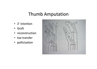 Thumb Amputation
• 2’ intention
• Graft
• reconstruction
• toe transfer
• pollicization
 