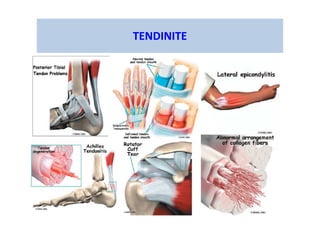 TENDINITE
 