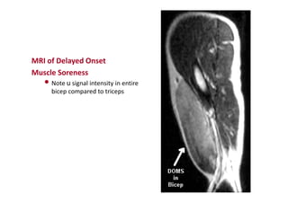 MRI of Delayed Onset
Muscle Soreness
• Note u signal intensity in entire
bicep compared to triceps
 