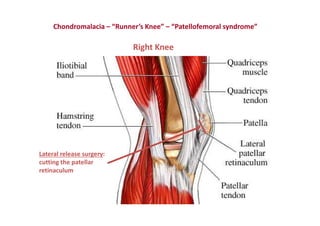 Figura
Right Knee
Chondromalacia – “Runner’s Knee” – “Patellofemoral syndrome”
Lateral release surgery:
cutting the patellar
retinaculum
 