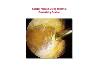 Lateral release Using Thermal
Cauterizing Scalpel
 