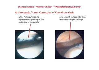 Arthroscopic / Laser Correction of Chondromalacia
white “whispy” material
represents roughening of the
underside of the patella
new smooth surface after laser
removes damaged cartilage
Chondromalacia – “Runner’s Knee” – “Patellofemoral syndrome”
 