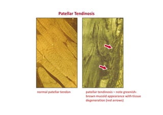 Patellar Tendinosis
normal patellar tendon patellar tendinosis – note greenish-
brown mucoid appearance with tissue
degeneration (red arrows)
 