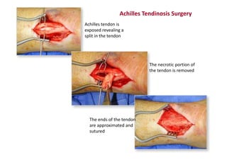 Achilles Tendinosis Surgery
Achilles tendon is
exposed revealing a
split in the tendon
The necrotic portion of
the tendon is removed
The ends of the tendon
are approximated and
sutured
 