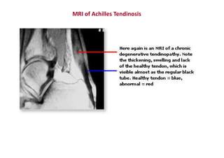 MRI of Achilles Tendinosis
 