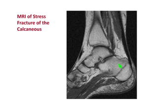 MRI of Stress
Fracture of the
Calcaneous
 