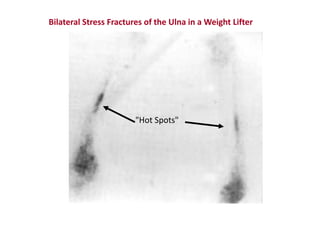 Bilateral Stress Fractures of the Ulna in a Weight Lifter
"Hot Spots"
 