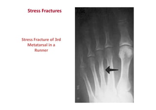 Stress Fracture of 3rd
Metatarsal in a
Runner
Stress Fractures
 