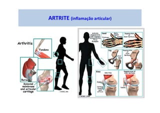 ARTRITE (inflamação articular)
 