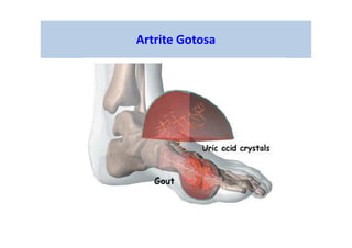 Artrite Gotosa
 