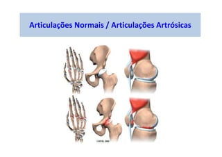 Articulações Normais / Articulações Artrósicas
 