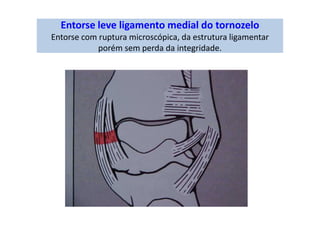 Entorse leve ligamento medial do tornozelo
Entorse com ruptura microscópica, da estrutura ligamentar
porém sem perda da integridade.
 