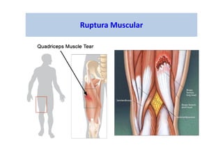 Ruptura Muscular
 