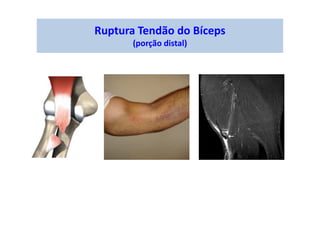 Ruptura Tendão do Bíceps
(porção distal)
 