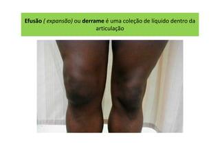 Efusão ( expansão) ou derrame é uma coleção de líquido dentro da
articulação
 