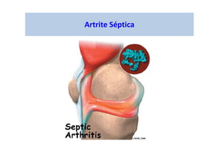 Artrite Séptica
 