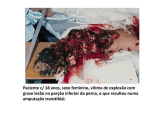 Paciente c/ 18 anos, sexo feminino, vítima de explosão com
grave lesão na porção inferior da perna, o que resultou numa
amputação transtibial.
 