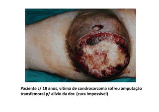 Paciente c/ 18 anos, vítima de condrosarcoma sofreu amputação
transfemoral p/ alívio da dor. (cura impossível)
 