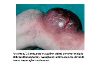 Paciente c/ 75 anos, sexo masculino, vítima de tumor maligno
(Fibrous Histiocytoma). Evolução nos últimos 6 meses levando
à uma amputação transfemoral.
 
