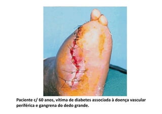Paciente c/ 60 anos, vítima de diabetes associada à doença vascular
periférica e gangrena do dedo grande.
 