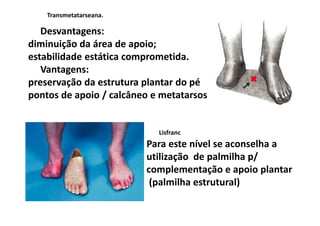 Desvantagens:
diminuição da área de apoio;
estabilidade estática comprometida.
Vantagens:
preservação da estrutura plantar do pé
pontos de apoio / calcâneo e metatarsos
Transmetatarseana.
Lisfranc
Para este nível se aconselha a
utilização de palmilha p/
complementação e apoio plantar
(palmilha estrutural)
 