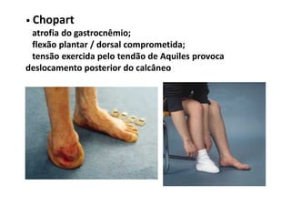 • Chopart
atrofia do gastrocnêmio;
flexão plantar / dorsal comprometida;
tensão exercida pelo tendão de Aquiles provoca
deslocamento posterior do calcâneo
 