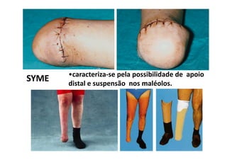 •caracteriza-se pela possibilidade de apoio
distal e suspensão nos maléolos.
SYME
 