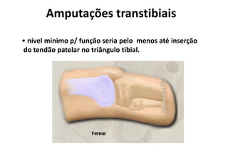 Amputações transtibiais
• nível mínimo p/ função seria pelo menos até inserção
do tendão patelar no triângulo tibial.
 