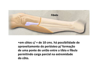 •em côtos c/ + de 10 cms. há possibilidade de
aproveitamento do periósteo p/ formação
de uma ponte de união entre a tíbia e fíbula
permitindo carga parcial na extremidade
do côto.
 