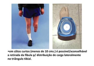 •em côtos curtos (menos de 10 cms.) é possível/aconselhável
a retirada da fíbula p/ distribuição de carga lateralmente
no triângulo tibial.
 