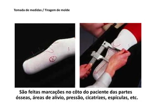 Tomada de medidas / Tiragem de molde
São feitas marcações no côto do paciente das partes
ósseas, áreas de alívio, pressão, cicatrizes, espículas, etc.
 