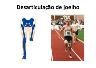 Desarticulação de joelho
 