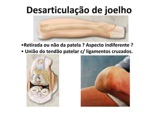 Desarticulação de joelho
•Retirada ou não da patela ? Aspecto indiferente ?
• União do tendão patelar c/ ligamentos cruzados.
 