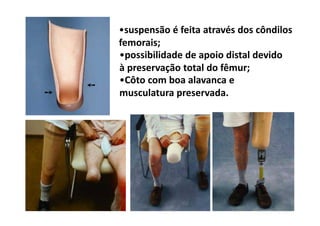 •suspensão é feita através dos côndilos
femorais;
•possibilidade de apoio distal devido
à preservação total do fêmur;
•Côto com boa alavanca e
musculatura preservada.
 