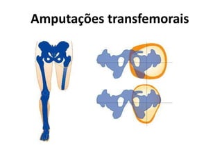Amputações transfemorais
 