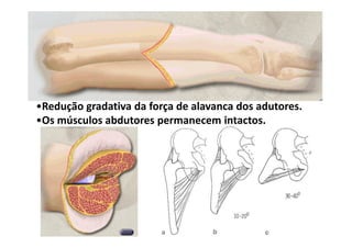 •Redução gradativa da força de alavanca dos adutores.
•Os músculos abdutores permanecem intactos.
 