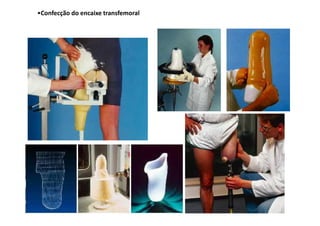 Figura
•Confecção do encaixe transfemoral
 