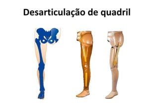Desarticulação de quadril
 